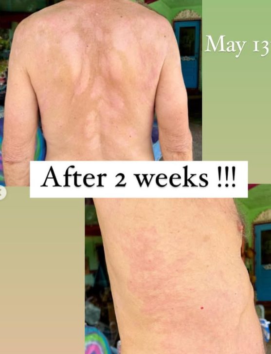 The same adult's back largely clear after two weeks
