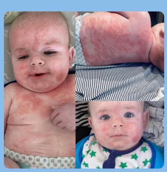 Baby boy with eczema on face, chest and arm before treatment