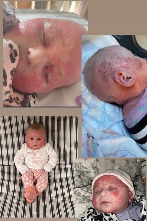 Baby girl with severe eczema on face and scalp before treatment