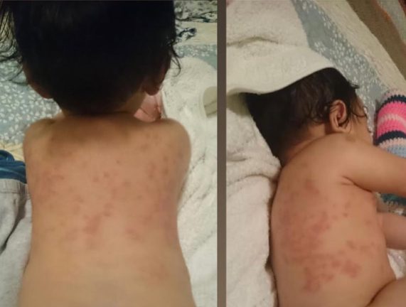 Toddler with eczema patches across the back before treatment